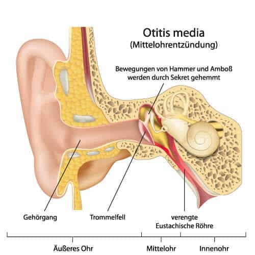Querschnitt des Ohres mit sichtbarer Sekretion bei Mittelohrentzündung