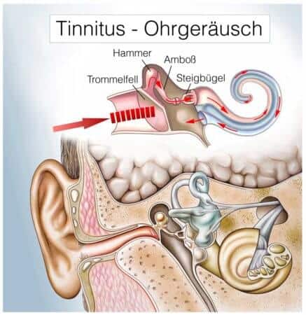 Aufbau des Gehörs mit Erklärung, wie Tinnitus entsteht.